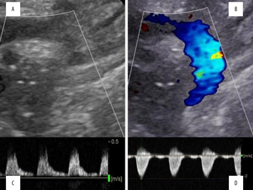(A–D) Echocardiogram of the aortic arch after surgery showing improvement and normalization of the findings illustrated in Figure 2.