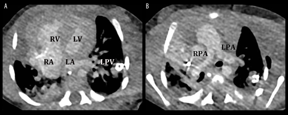 Computed tomography angiography. (A) Dextroposition of the heart, relative right lung hypoplasia, and displaced communication between the left pulmonary veins (LPV) and left atrium (LA). (B) Relatively hypoplastic right pulmonary artery (RPA). LV – left ventricle, RA – right atrium, RV – right ventricle.