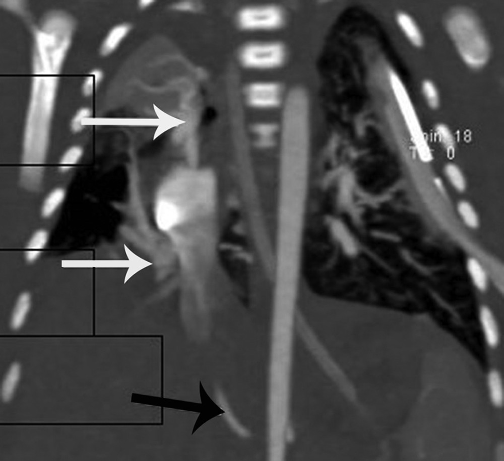Computed tomography angiography demonstrating a variant of scimitar syndrome. The white arrows point to right upper and right lower pulmonary vein drainage into the superior and inferior vena cava, respectively. The black arrow points to an aortopulmonary collateral artery running from the celiac trunk toward the right lower lobe of the lung.
