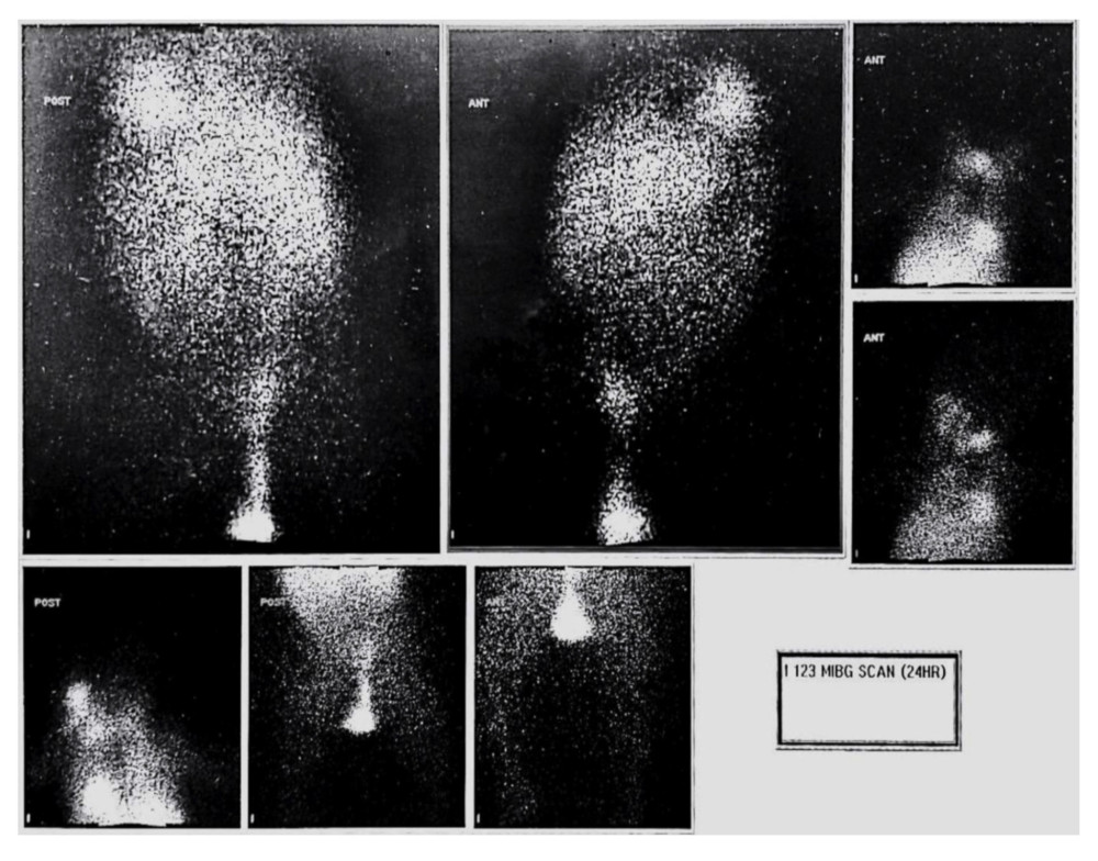 Posterior and anterior whole-body metaiodobenzylguanidine (MIBG) scintigraphy was performed using 370 MBq of iodine-123. Multiple spot images of the entire body were collected 24 h after radionuclide administration, showing normal physiologic MIBG uptake in brown fat, nasal mucosa, and salivary glands, heart, liver, and bowel, with excretion activity in the bladder.