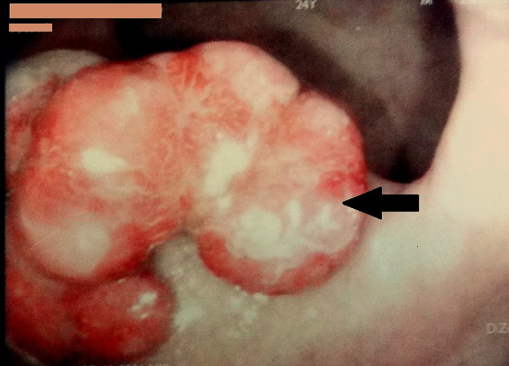 Endoscopic image shows large kidney shape rectal polypoid mass with wide base (indicated by the arrow).