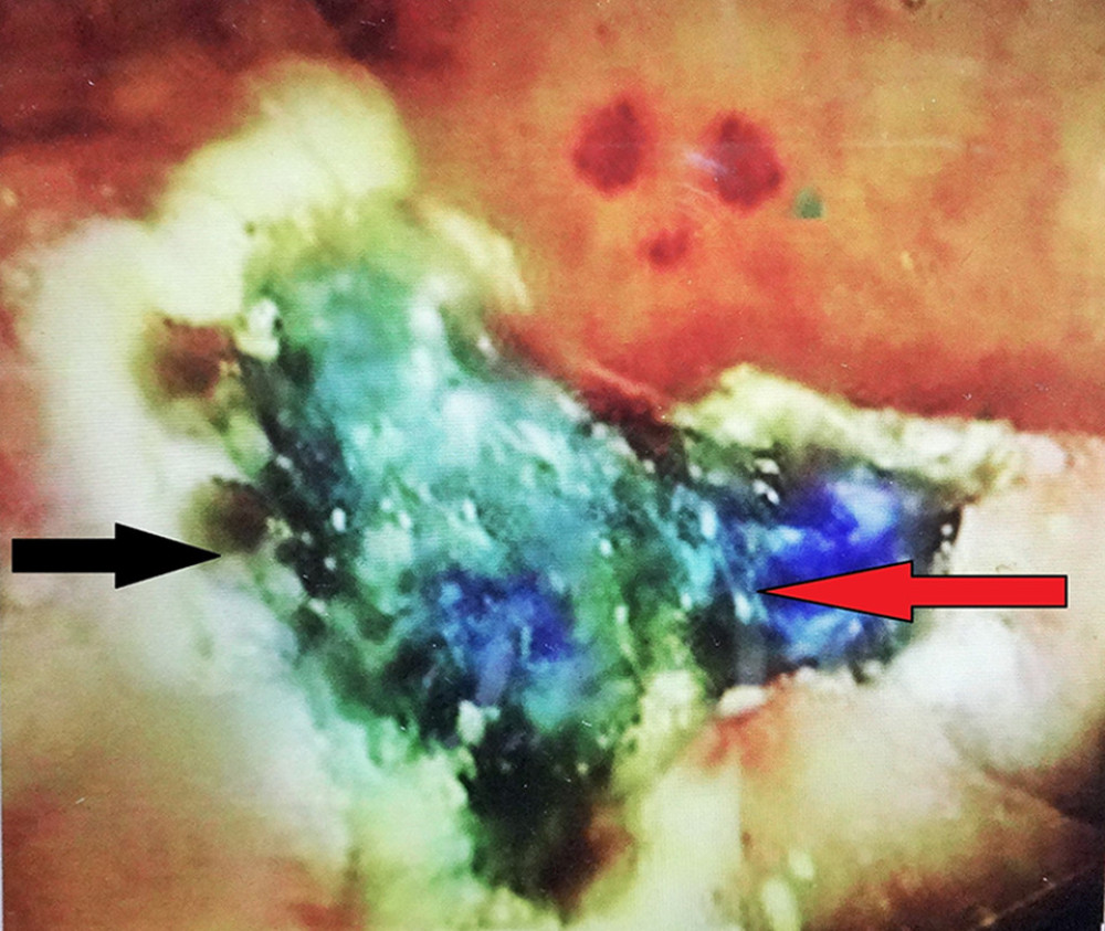 Endoscopic image showing the site of the polyp after endoscopic mucosal resection (EMR) with clear margins (black arrow) indicating complete resection. The blue color is the sub mucosa stained with methylene blue (red arrow).