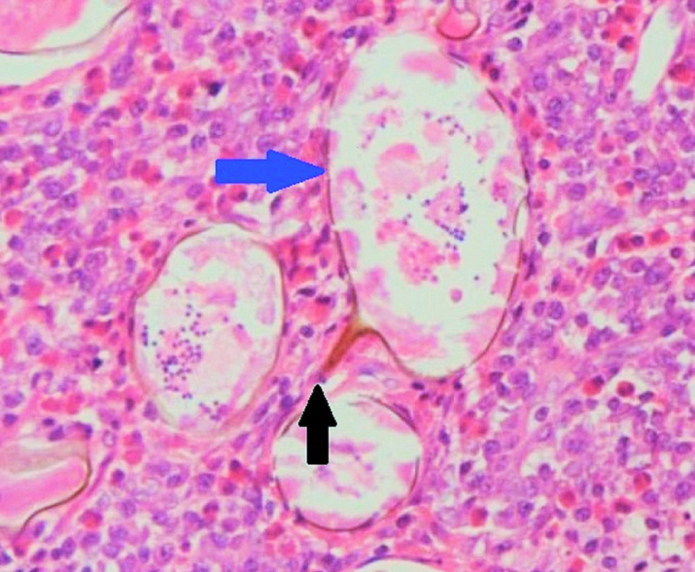 Histopathology image showing oval shape eggs (170–115×65–40 µm) (blue arrow) with a sharp lateral spine (black arrow) which indicate Schistosoma mansoni eggs.