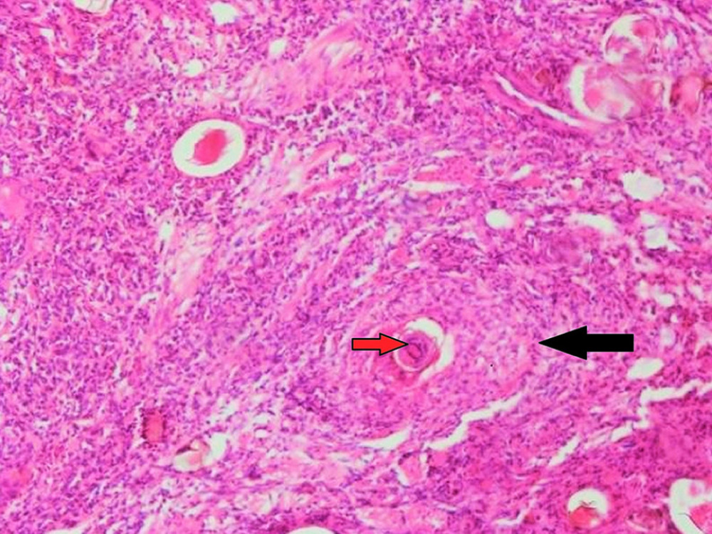 Histopathology image showing Schistosoma eggs at the center (red arrow) surrounded by a granuloma (black arrow), which indicates a chronic infection.