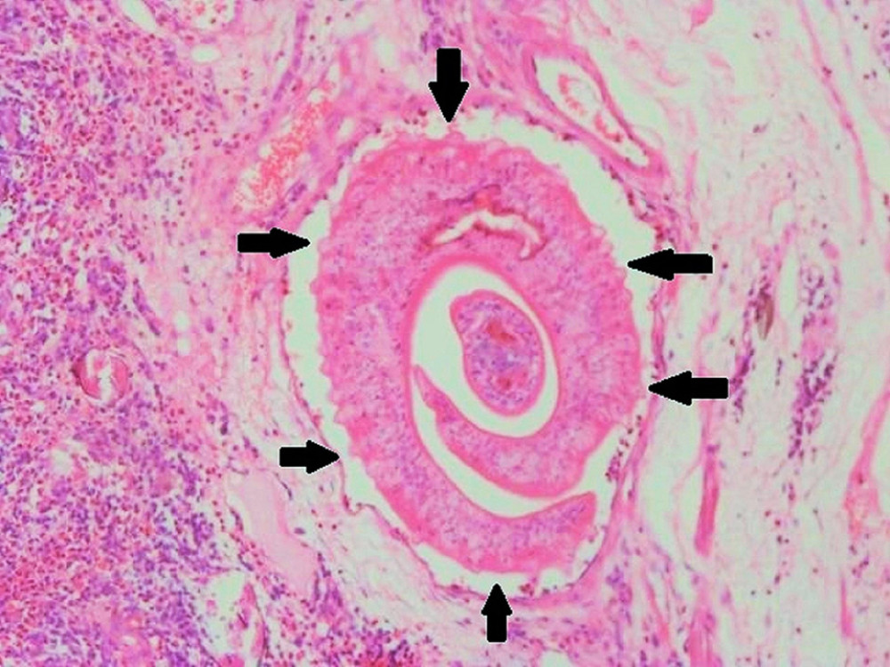 Histopathology image showing elongate tubular snail shape Schistosoma worms (multiple arrows).