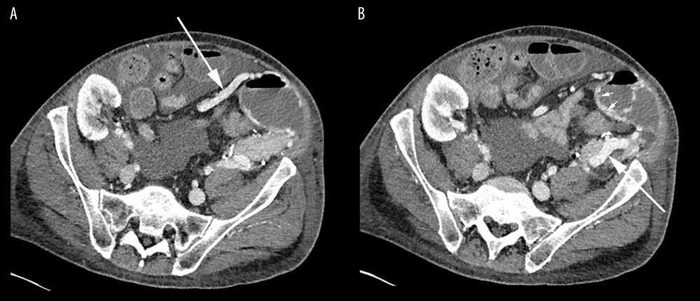 Contrast-enhanced CT demonstrates (A) a dilated jejunal vein (long arrow) related to the dilated donor duodenum, within the wall of which (B) numerous varices are seen (short arrows) communicating with the pancreatic graft portal vein (long arrow).