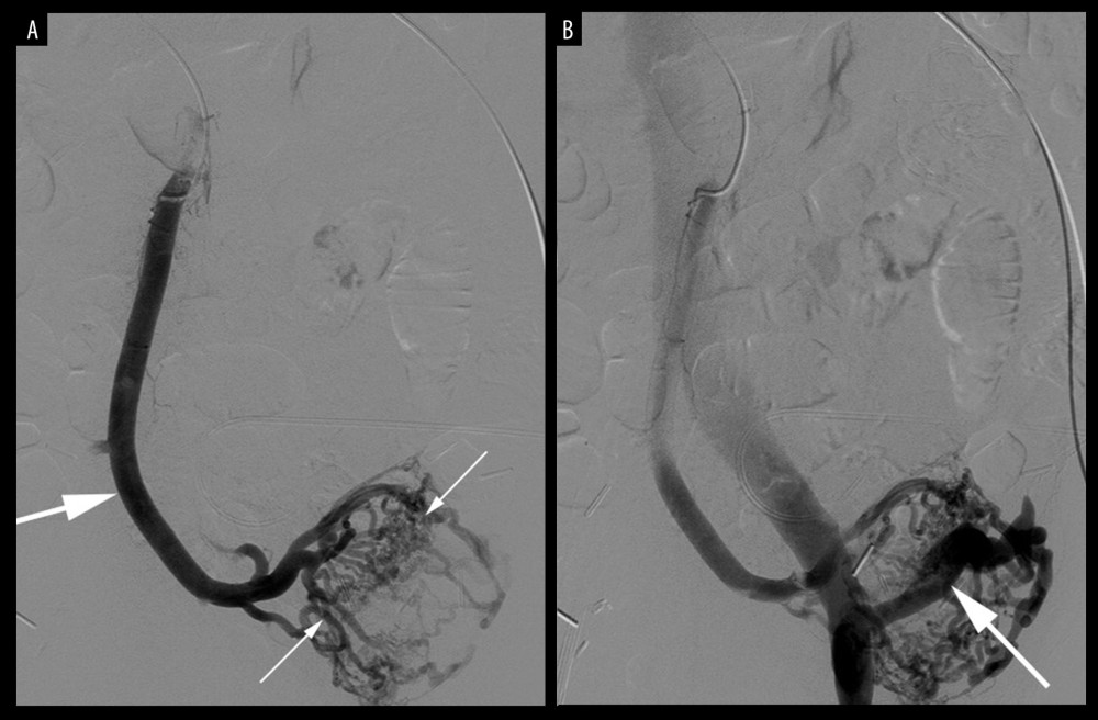 Superior mesenteric venogram performed via a transhepatic portal venous approach demonstrates (A) retrograde flow in the jejunal vein (long arrow) and numerous trans-anastomotic varices (between short arrows) in the wall of the donor duodenum. There is rapid drainage (B) into the pancreatic graft portal vein (arrow) and then into the external iliac vein and inferior vena cava.