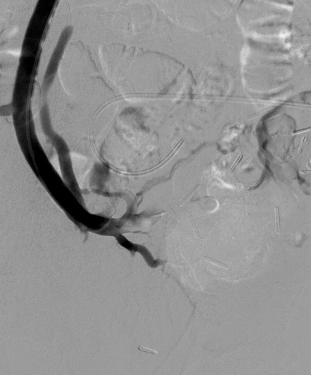 Superior mesenteric venography performed after selective embolization with 3% sodium tetradecyl sulphate shows complete obliteration of porto-systemic shunting and preserved patency of the jejunal vein.