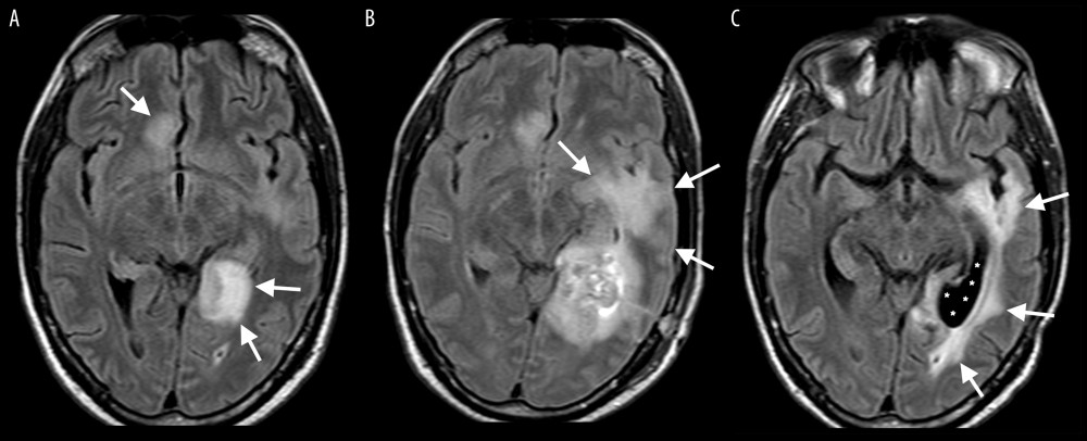 Imaging studies. (A) FLAIR images at presentation. Note circumscribed heterogenous 4-cm mass-like lesion in the left occipital lobe (arrows). Note also a 15-mm lesion with similar single characteristics within the medial right frontal lobe (arrow). Further areas of edema are present in the splenium of the corpus callosum and temporal lobe on the left, which correlate with the patient’s alexia without agraphia and right superior quadrantanopia, respectively. FLAIR images are shown. T1, T2, diffusion, and contrast-enhanced imaging modes revealed partial restricted diffusion and enhancement, but these abnormalities are more marked on FLAIR images. (B) FLAIR images following biopsy. Ten days later, there was significant deterioration with extension of the edema into the left temporal lobe and a mild mass effect (arrows). A more circumscribed focus of high signal intensity within the center of the lesion represents hematoma following biopsy. The right frontal lesion is unchanged. (C) FLAIR images at day 140. Follow-up scan 5 months later demonstrates resolution of the edema on the left, with significant dilatation of the posterior horn of the left lateral ventricle, consistent with ex-vacuo dilatation (asterisks). The high signal intensity within the left temporal lobe, which continues around the dilated posterior horn, is well-demarcated and is consistent with gliosis (arrows).