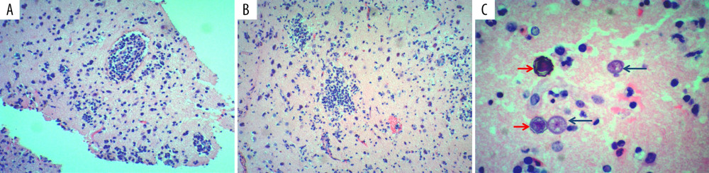 Histopathology. (A) Low-power magnification H&E photomicrographs of brain histology. Fragments of grey and white matter showing perivascular and parenchymal chronic inflammation, composed of lymphocytes, macrophages, and microglial cells. Rare multinucleated giant cells are seen (H&E ×10 objective). (B) Low-power magnification H&E photomicrographs of brain histology. Several variably sized aggregates of microglial cells forming microglial nodules are seen (H&E ×10 objective). (C) High-power magnification H&E photomicrographs of brain histology. Multiple rounded organisms are seen. The majority have a well-defined capsule with abundant granular/vacuolated cytoplasm, a round nucleus, and prominent central karyosome, consistent with amoebic trophozoites (blue arrows). Smaller ones have dark nuclei with a wrinkled and rather refractile outer capsule, consistent with amoebic cysts (red arrows) (H&E ×40 objective).