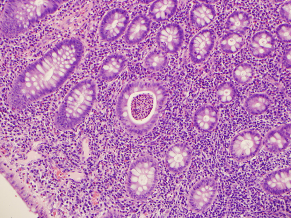 Inflammatory polyp with crypt abscess (hematoxylin and eosin-stained section, original magnification 100×).
