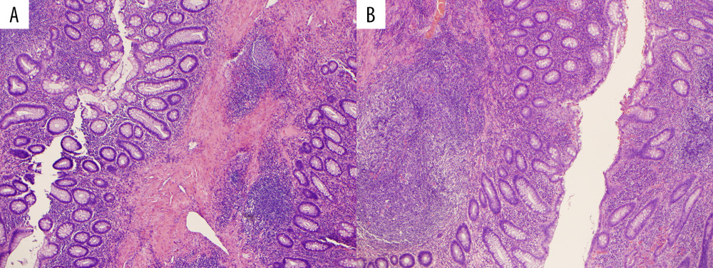 (A, B) Mucosal and sub-mucosal lymphoid aggregates are present (hematoxylin and eosin-stained sections, original magnification 40×, 20×, respectively).