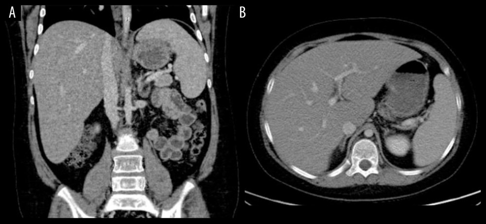 (A) CT scan abdomen (coronal plane) showing decreased liver density compared to spleen. (B) CT scan abdomen (axial plane) showing decreased liver density compared to spleen.