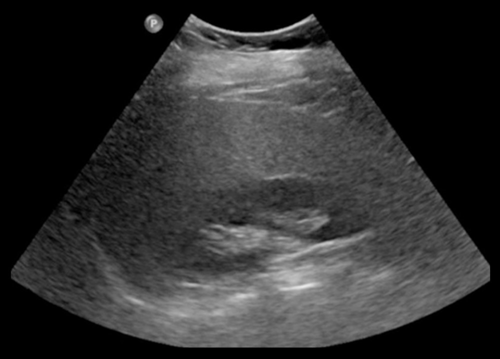 Ultrasound abdomen showing increased liver echogenicity compared to kidney.