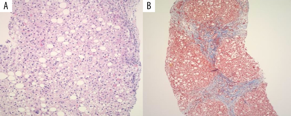 (A) High magnification (×40) H&E staining revealing steatohepatitis. (B) High magnification (×40) trichrome staining revealing bridging and encircling fibrosis consistent with evolving cirrhosis.