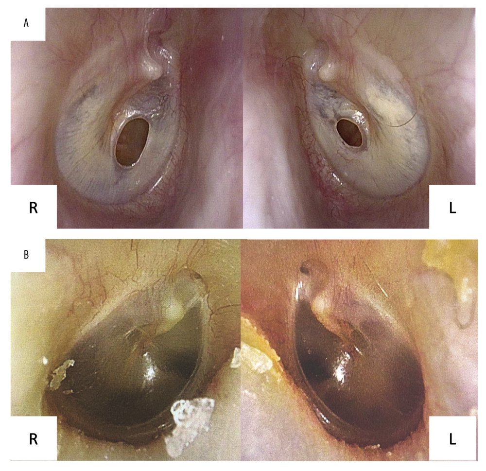 The otoscopic findings. (A) Both tympanic membranes were thickened and perforated. (B) Normal findings of tympanic membrane. R – right, L – left.