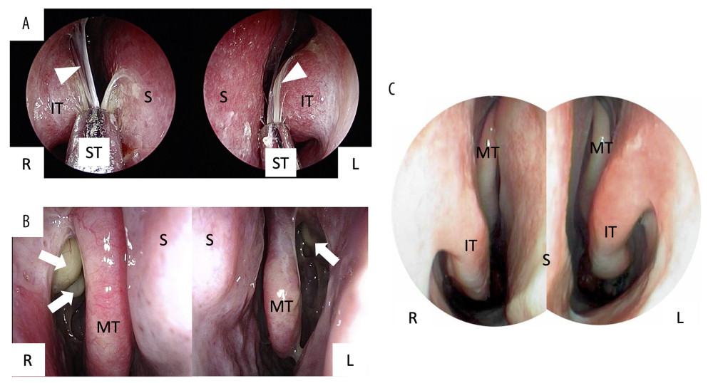 The nasal endoscopic findings. (A) White viscous nasal discharge secreted in both sides of the nasal cavity (white arrow heads). (B) Yellowish bulging lesions occupied both sides of the middle nasal meatus (white arrows). (C) Normal findings of nasal cavity. IT – inferior turbinate, MT – middle turbinate, S – septum, ST – suction tube.