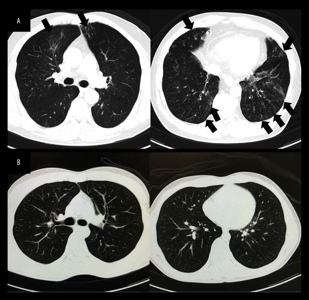 (A) Chest computed tomography images showing diffuse small nodular shadows in both lung fields (black arrows). (B) Normal findings of chest computed tomography images.