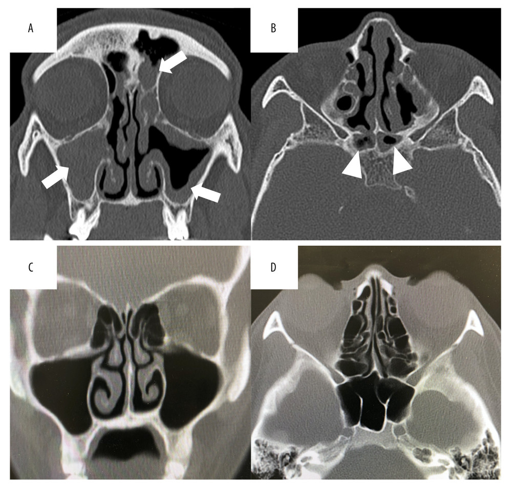 Sinus computed tomography images. (A) Coronal view showing soft-tissue shadows in the bilateral paranasal sinuses (white arrows). (B) Horizonal view showing sphenoid sinuses hypoplasia (white arrow heads). (C) Normal findings of coronal view. (D) Normal findings of horizonal view.