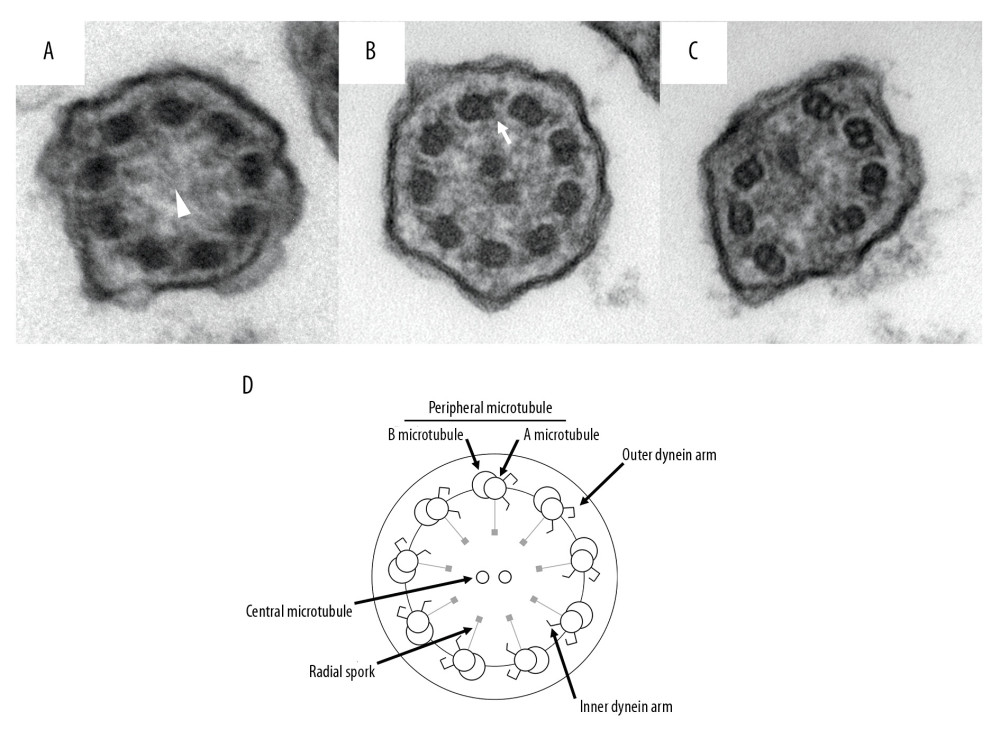 The electron microscopic analysis of the nasal cilia. (A) Central complex defect (white arrow head). (B) Inner dynein arm defect (white arrow). (C) Microtubular disorganization and inner dynein arm defect. (D) The schema of electron microscopic findings of normal cilia. Normal cilia have 2 central microtubules and 9 pairs of peripheral microtubules. A pair of peripheral microtubules consists of A microtubule and B microtubule. Outer and inner dynein arms are attached to A microtubules.