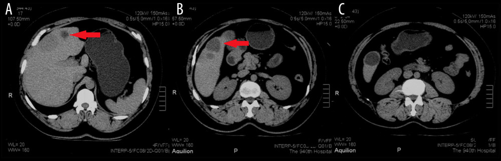 (A–C) July 30, 2019 re-examination of computed tomography in our hospital showed that multiple round low-density shadows could be seen in the left lobe and the front segment of the right lobe, with blurred boundaries, and the larger one was about 3.9×3.8 cm, which was diagnosed as multiple liver cysts. The arrow in A shows a hepatic hemangioma. The arrow in B shows the hepatic hydatid.