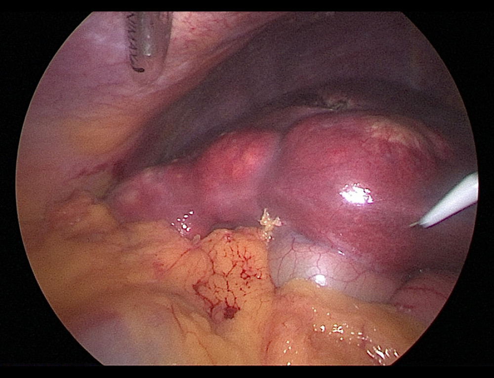 During the operation, laparoscopic exploration revealed that there were three circle-like firm and rubbery masses at the lower margin of the right lobe of the liver, which suggested the possibility of hepatic hydatid cyst.