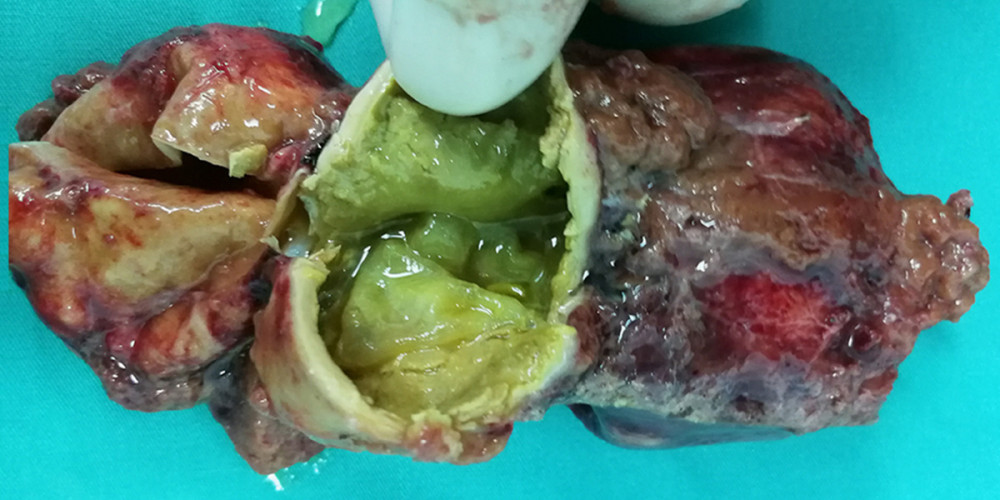 The postoperative specimen was a thick-walled firm and rubbery cystic mass containing yellow viscous cystic fluid.