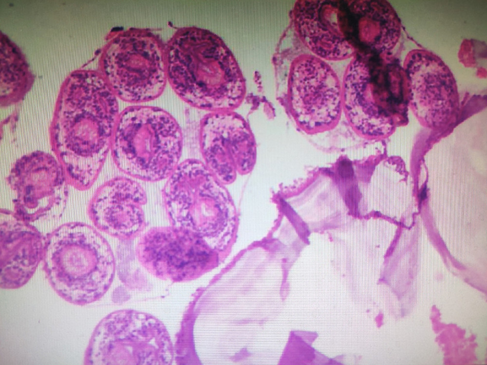 Postoperative pathology showed chronic granulomatous inflammation of the liver accompanied by coagulative necrosis and cystic changes, with a few scolex, which was considered as hepatic hydatid cysts.