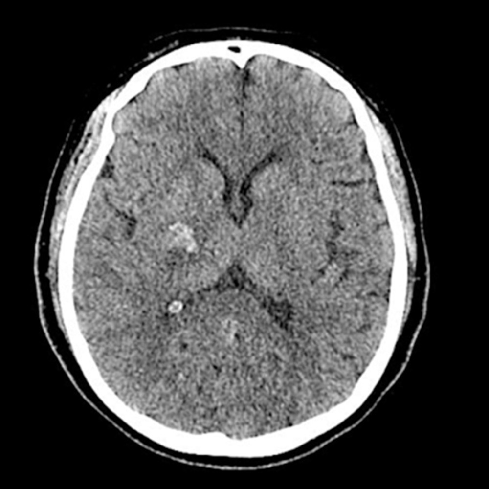 Non-contrast brain computed tomography showing intracranial hemorrhage on the right basal ganglia, right thalamus, and right periventricular white matter.