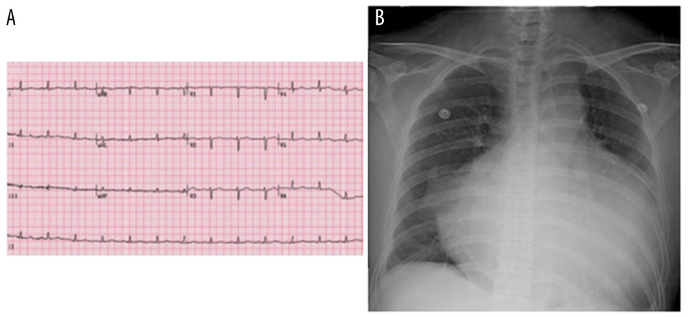 (A) Electrocardiogram showing normal sinus rhythm. (B) Chest X-ray showing the “water bottle” sign, indicating a large cardiomegaly.