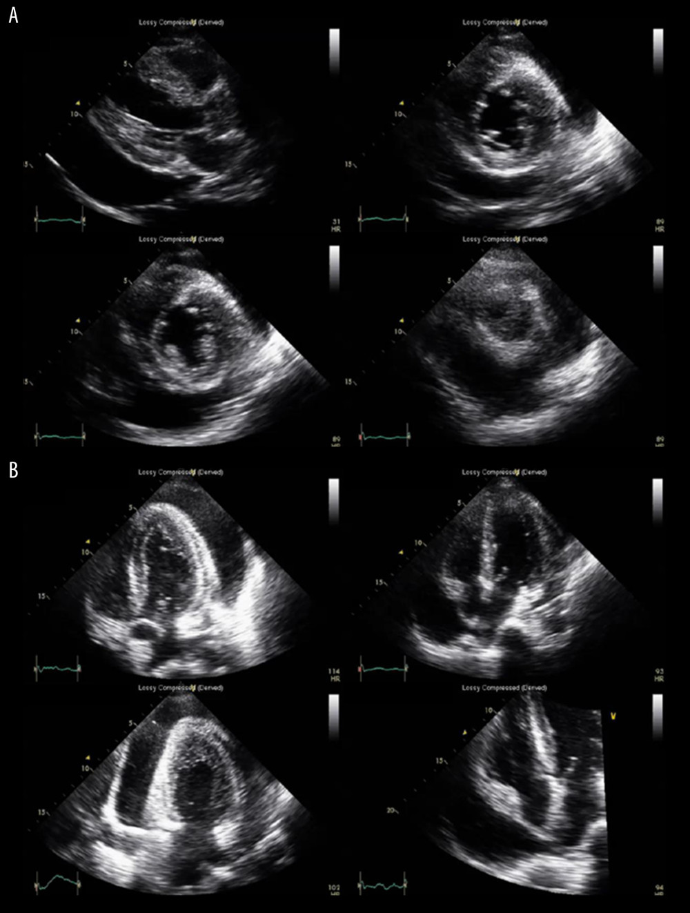 Pre-pericardiocentesis echocardiographic findings. Transthoracic echocardiography showed a circumferential large amount of pericardial effusion (maximal thickness, about 30 mm at the posterior side of the ventricular wall) with slight compression of the right atrium and right ventricle. Left ventricular systolic function was preserved. (A) A large amount of pericardial effusion was observed on the parasternal long-axis view and parasternal short-axis views. (B) A large amount of pericardial effusion was also observed in various apical views.