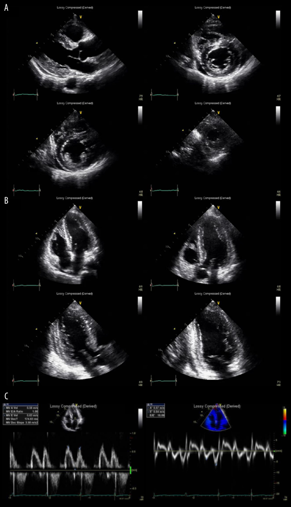 Post-pericardiocentesis echocardiographic findings. (A) Pericardial effusion was not observed on the parasternal long-axis view or parasternal short-axis views. Definite concentric left ventricular hypertrophy was detected on the parasternal long-axis view. (B) Pericardial effusion was not observed on various apical views. (C) The mitral valve inflow velocity in terms of E and A velocity and mitral annulus tissue Doppler velocity as e’ and a’ velocities were clearly detected after pericardiocentesis.