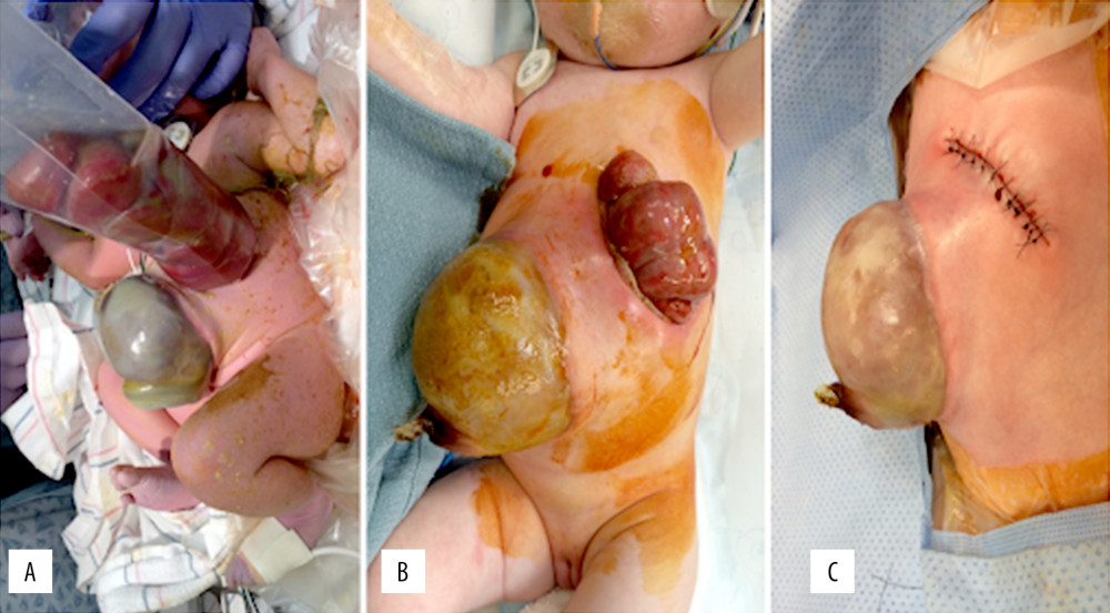 (A) Omphalocele and a left-sided gastroschisis containing eviscerated small bowel in a silo; (B) Following removal of the silo before closure; (C) After closure of left-sided gastroschisis.
