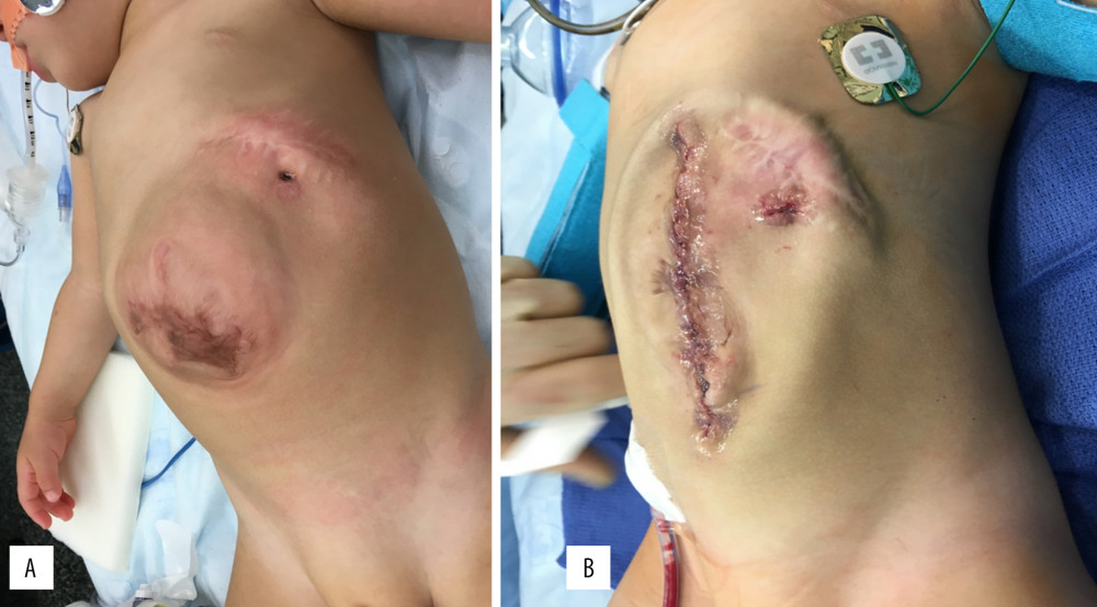 Before (A) and after repair of the omphalocele and takedown of the gastrocutaneous fistula (B).