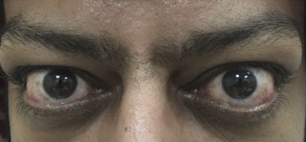 Typical eye manifestations of Graves’ disease; proptosis and periorbital edema.