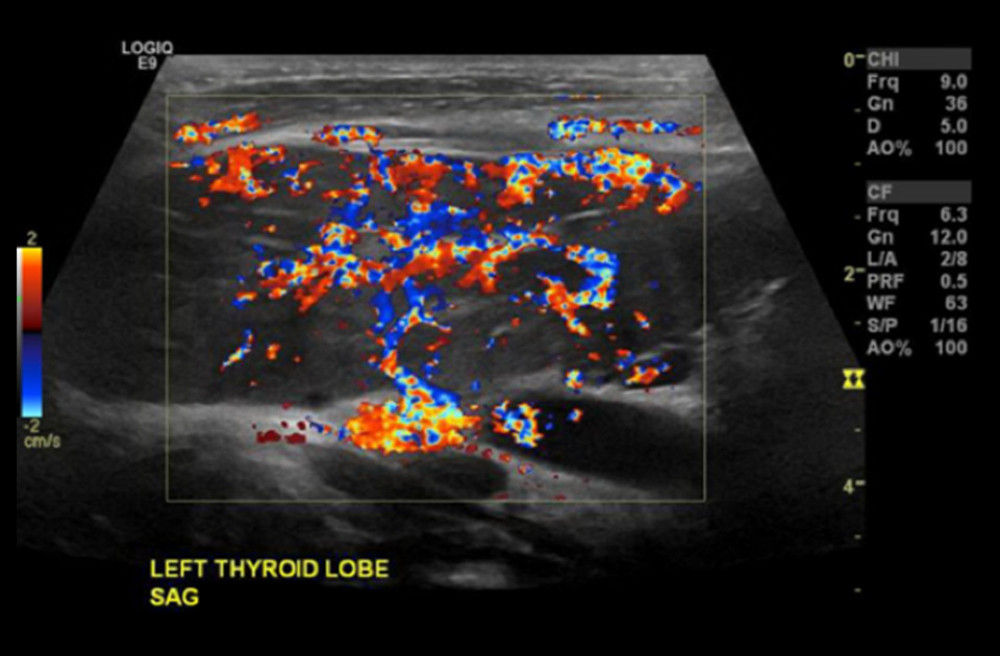 Ultrasound showing an enlarged and hypervascular left thyroid lobe with no suspicious nodules.