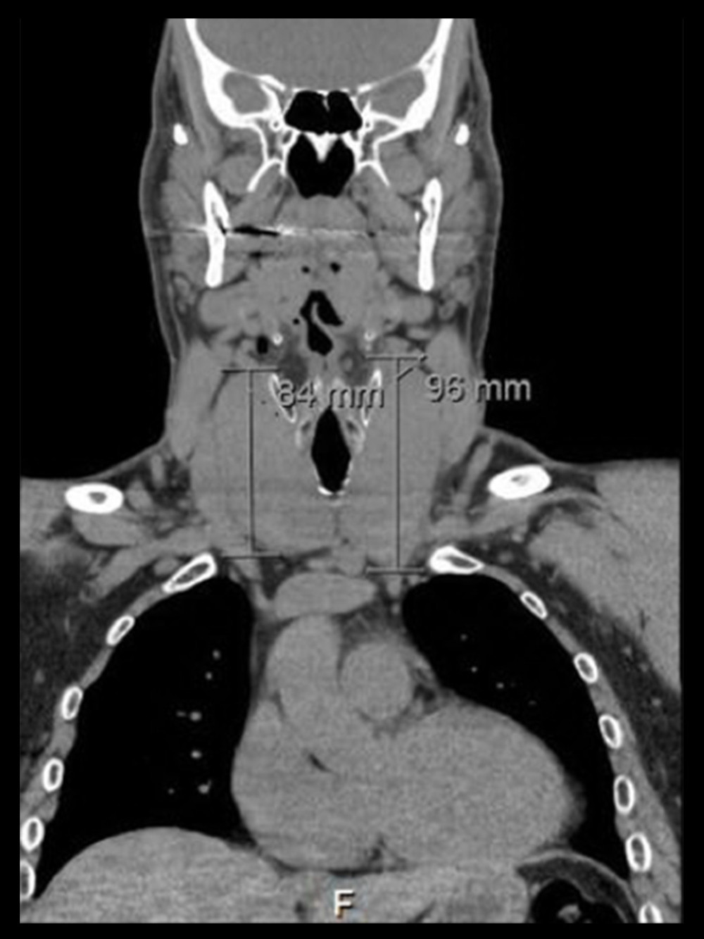 CT scan showing diffuse enlargement of the thyroid with no retrosternal extension or invasion of surrounding structures.