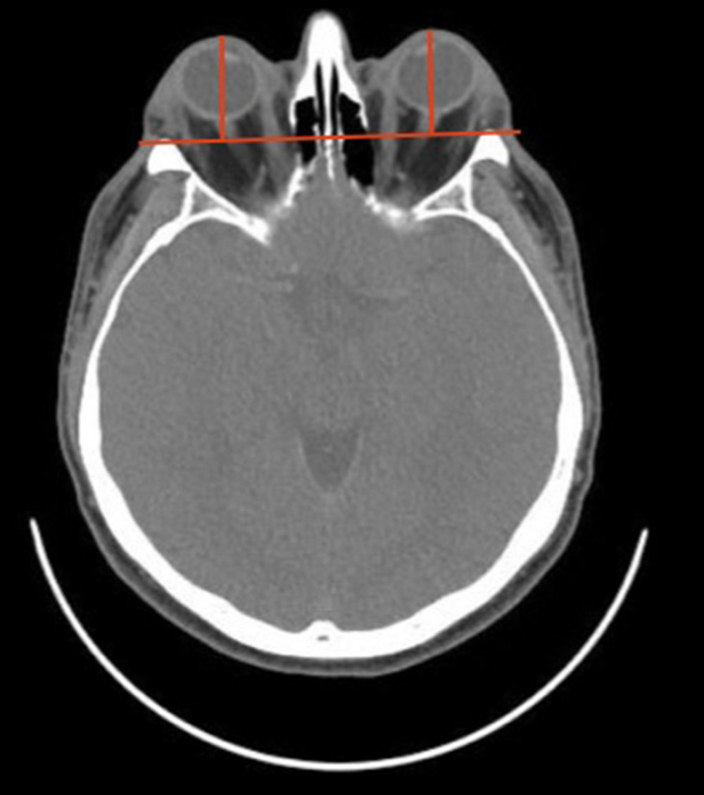 CT scan demonstrating that the distance from the anterior margin of the globe to the interzygomatic line exceeds 21 mm, indicating significant bilateral proptosis.