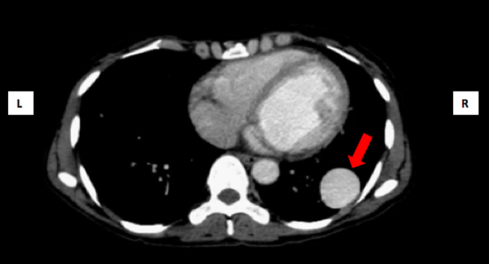 Computed tomography image in the arterial phase showing arteriovenous fistula (red arrow).