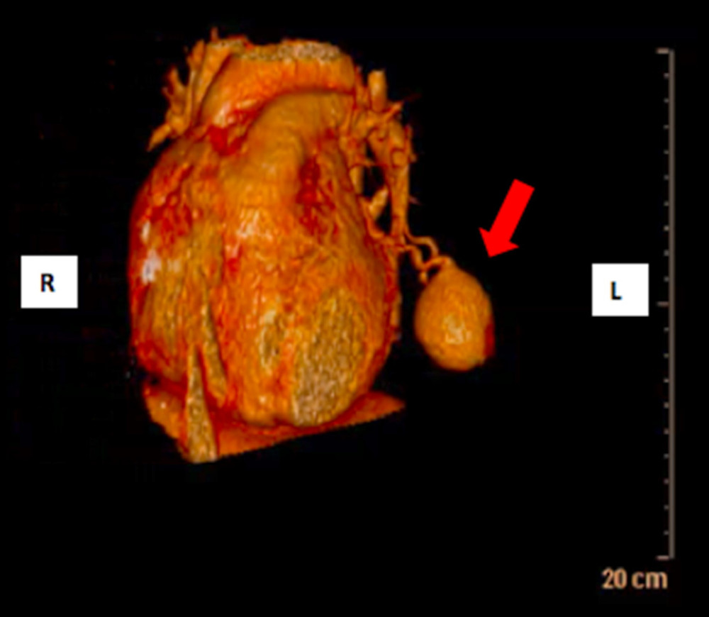 3D reconstruction of the arteriovenous fistula (red arrow), made from computed tomography images, to program the surgical approach.