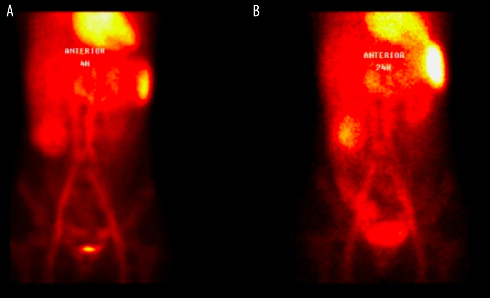 Scintigraphy images revealing an accumulation of radiotracer (Technetium- pyrophosphate -99m-labeled red blood cell) in the topography of the cecum (B), ascending colon, and transverse colon (A, B) in the late images, compatible with gastrointestinal bleeding.