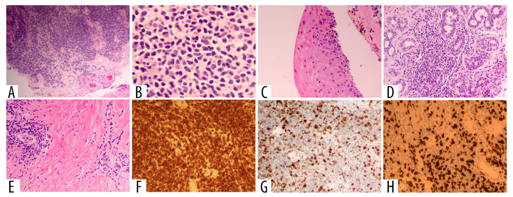 Histopathology and immunostaining profiles of mycosis fungoides palmaris et plantaris. (A) An infiltrate of the atypical lymphocytes in the upper dermis (hematoxylin and eosin [H&E], 40×1). (B) Round or ovoid atypical lymphocytes with cerebriform nuclear contour and no clear nuclear membrane or nucleoli (HE, 400×1). (C) Atypical lymphocytes infiltrating into the epidermis (epidermotropism) (HE, 100×1). (D) Atypical lymphocytes infiltrating into eccrine sweat glands (syringotropism) (HE, 100×1). (E) Perivascular infiltration of the atypical lymphocytes in the dermis (HE, 100×1). (F) Strong CD4 expression in atypical lymphocytes (3, 3 -diaminobenzidine [DAB], 100×1). (G) Reduced CD7 expression in atypical lymphocytes (DAB, 100×1). (H) Reduced CD8 expression in atypical lymphocytes (DAB, 100×1).