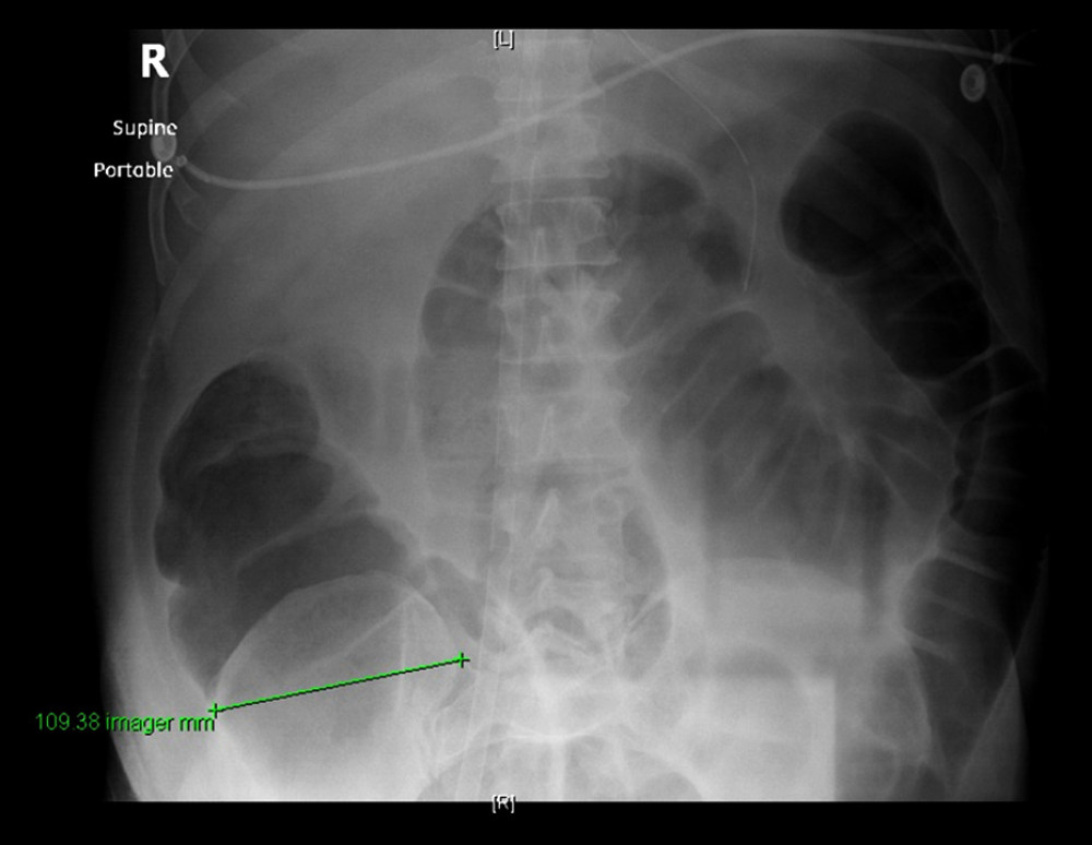 Abdomen X-ray shows colon dilation with cecal diameter about 10.9 cm.