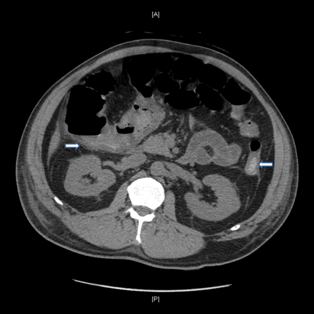 CT abdomen. Thickening and paracolonic fat stranding of proximal colon, hyperdensity in right hepatic flexure lumen consistent with blood (right arrow). Descending colonic wall thickening (left arrow).