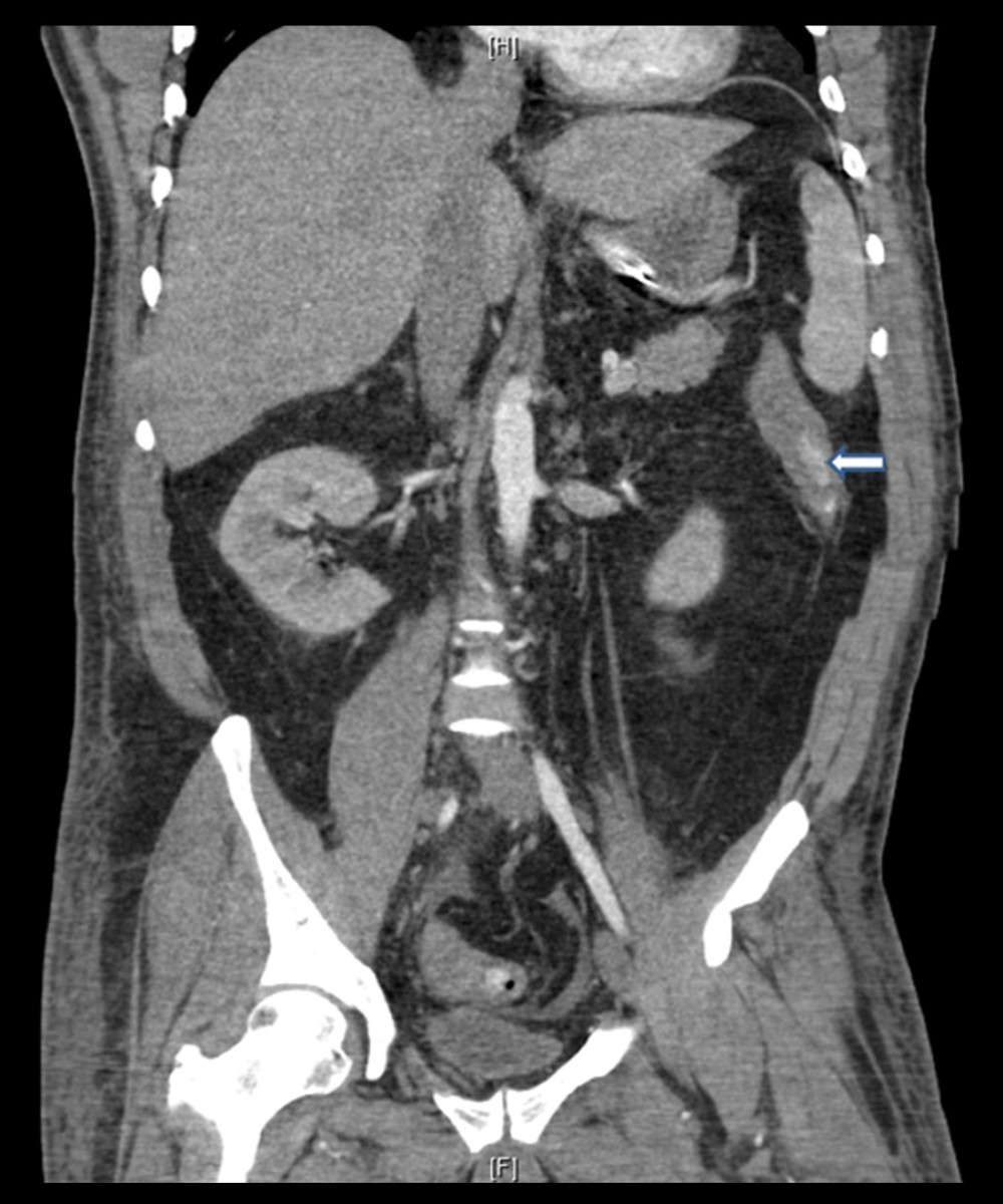 CT abdomen. Thickening of descending colon wall with hyperdense material in lumen, consistent with blood (arrow).