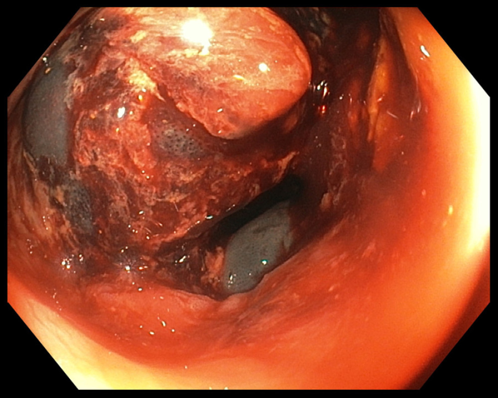 Colonoscopy showing congested, friable, necrotic and ulcerated mucosa, with hemorrhage in the ascending colon/hepatic flexure.
