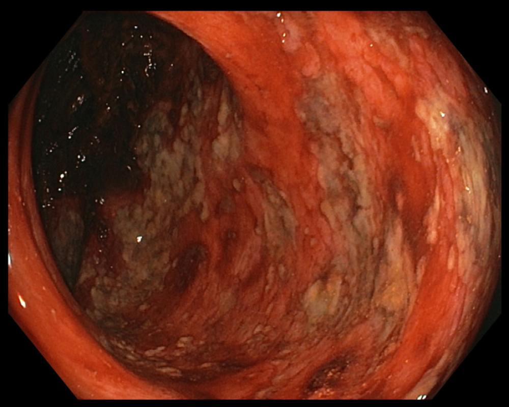 Colonoscopy showing erythema, congestion, necrotic and ulcerated mucosa, with areas of bleeding in the descending colon.