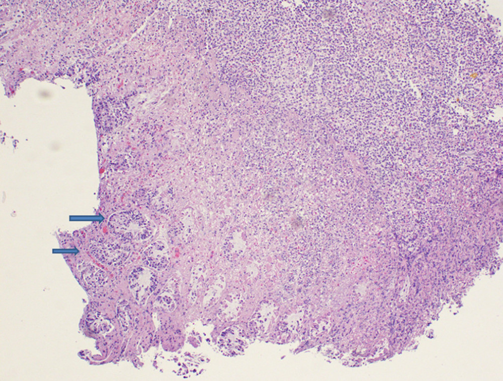 Colon biopsy showing loss of superficial crypts, preservation of base crypts (arrows), and voluminous inflammatory exudate.