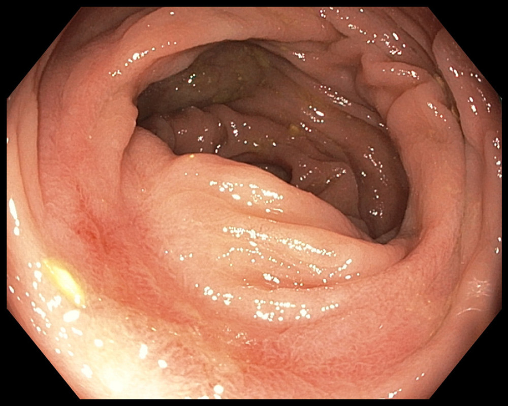 Image from splenic flexure during follow-up colonoscopy shows near resolution of inflammation and ulceration associated with resolving injury due to past colonic ischemia.