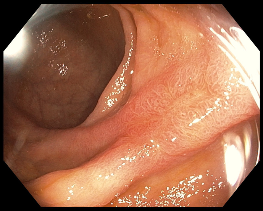 Image from ascending colon during follow-up colonoscopy shows near resolution of inflammation and ulceration associated with resolving injury due to past colonic ischemia.